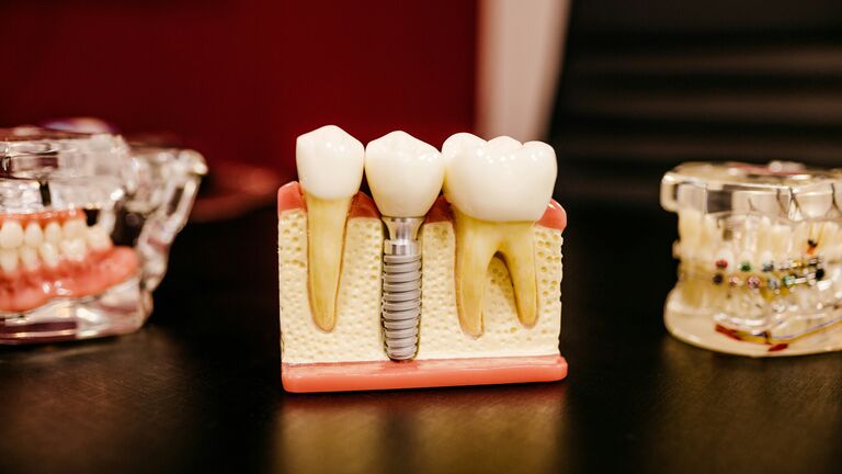 Dental Implants from £1,800: A Guide for Patients